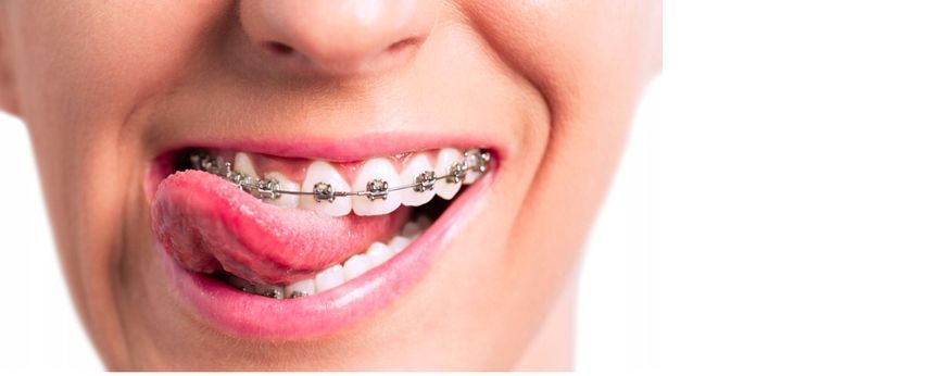 Sunstar (Санстар) GUM Ortho Orthodontic, 75 мл - зубна паста для ортодонтичних брекетів. 2553822883 фото